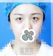 浙二叶娟双眼皮案例 魅力电眼绽放“睛”彩 width=