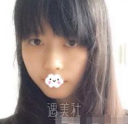 柳民熙隆鼻案例 来看看我这五万花的值不值 width=