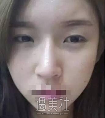 杭州维多利亚许凤芝双眼皮技术如何?真实案例一览~