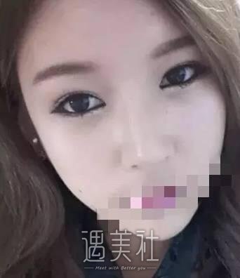 杭州维多利亚许凤芝双眼皮技术如何?真实案例一览~