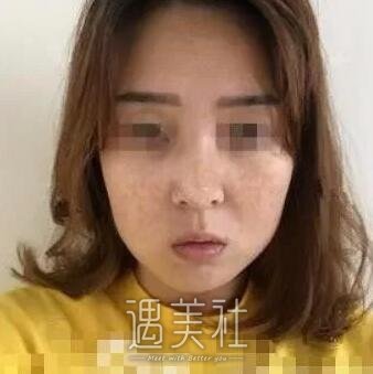 哈尔滨211医院激光祛斑实力如何?真实案例一览~