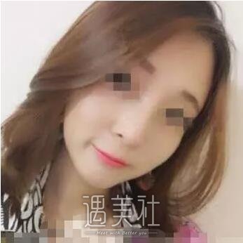 哈尔滨211医院激光祛斑实力如何?真实案例一览~