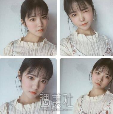 成都,自体脂肪填充