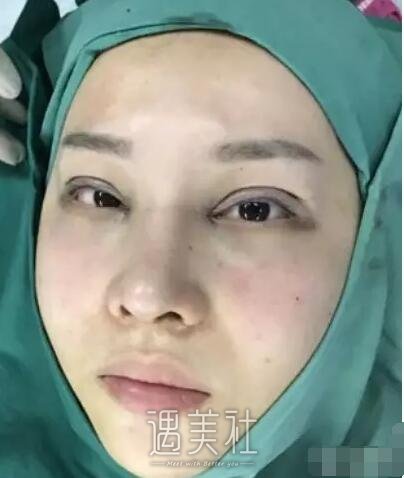 芜湖壹加壹医院双眼皮+开眼角案例分享，快来围观!