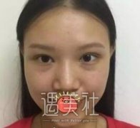 牛勇敢做鼻子怎么样？案例？ width=