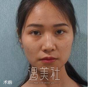 沈阳医大,黄威,隆鼻