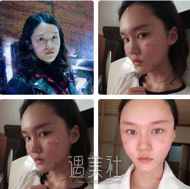 北京,冯斌,脂肪填充