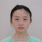 山大二院整形科双眼皮怎么样?亲身经历为你解答! width=