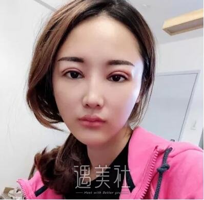 江苏省中医院整形双眼皮怎么样?有相关案例吗?
