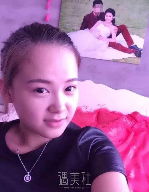 南京天熙隆鼻案例展示，丑与美就在一线之间!