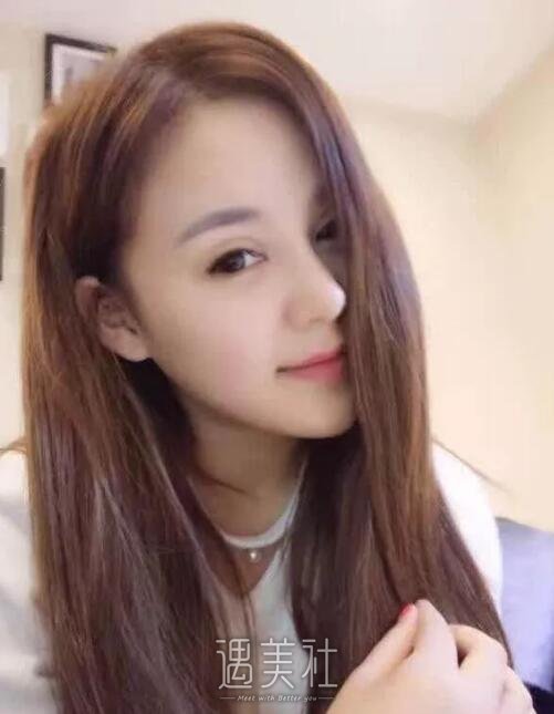 南京天熙隆鼻案例展示，丑与美就在一线之间!