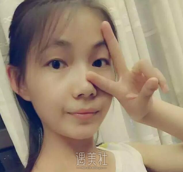 沧州京美做双眼皮好吗?做完整个人气质都变了!