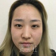 姜鑫利双眼皮案例：果灰常棒~ width=
