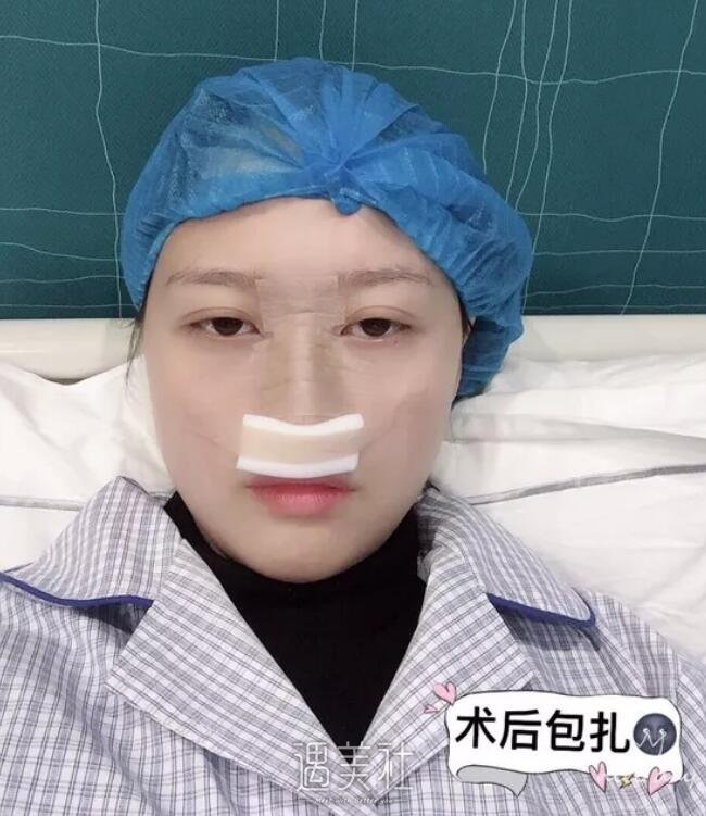 广西医科大整形医院隆鼻案例展示，小翘鼻就是好看!