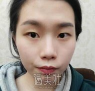 朱武根双眼皮案例：助我重拾自信~ width=