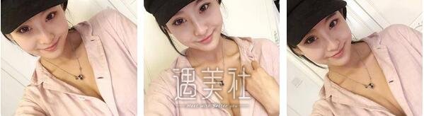 李发成,自体脂肪丰胸