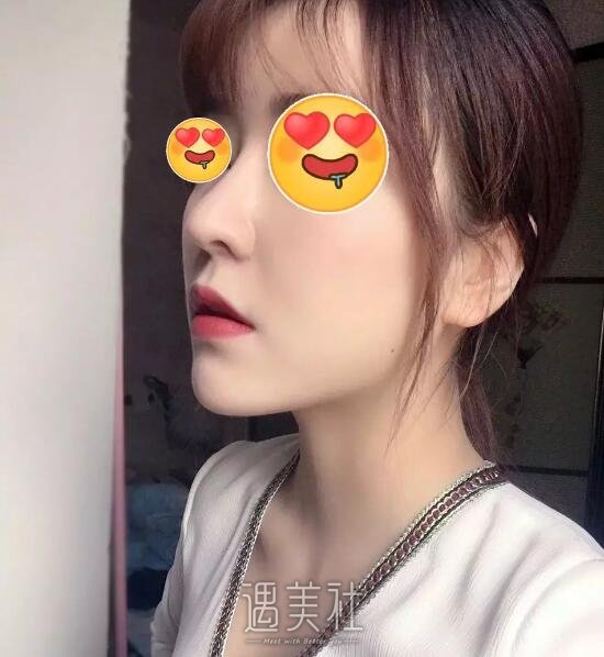 李鸿君修复鼻子案例|果很!