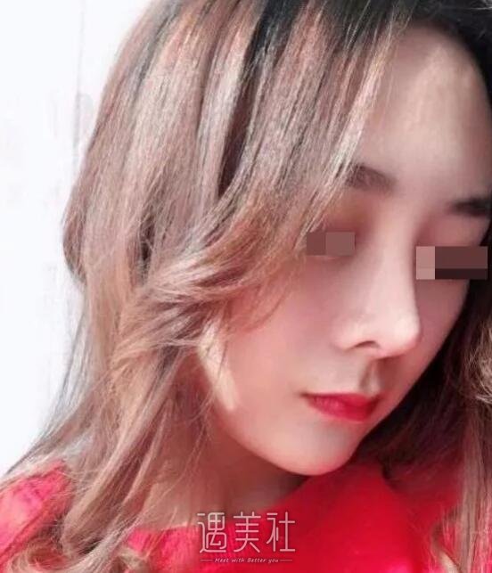 李青峰隆鼻案例展示|小姐姐的惊人蜕变!