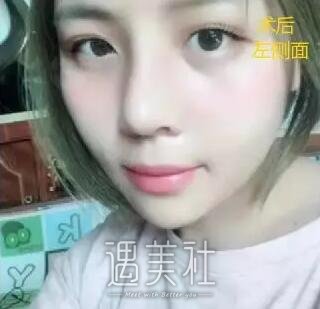 周长兵隆鼻案例分享|技术确实较为好!
