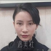 沈国雄双眼皮修复案例：真实前后恢复对比图~ width=