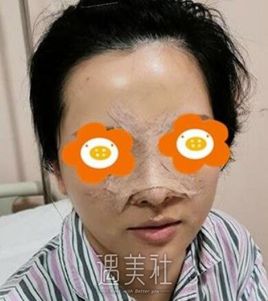 胡山,隆鼻