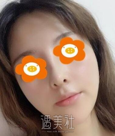 胡山,隆鼻