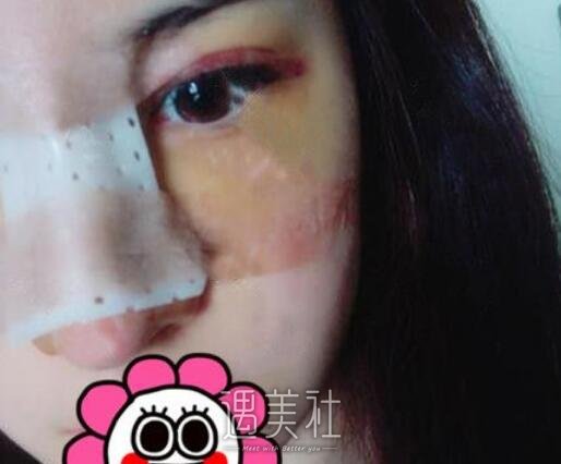 江华,隆鼻