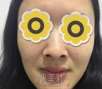 秦宏志双眼皮案例：感觉还不多错 width=