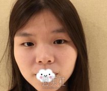 姜洪涛双眼皮案例:弧度也刚刚好 width=