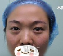 金海坤隆鼻案例:做过的鼻子更精致好看 width=