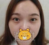 杜圆圆双眼皮案例：术后恢复全过程分享~ width=