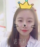 曹阳双眼皮案例|从此就能美美哒! width=