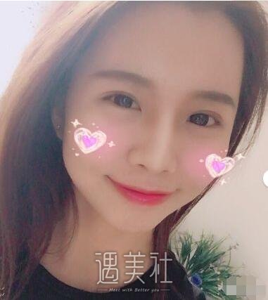 曹阳双眼皮案例|从此就能美美哒!
