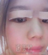 陈振宇双眼皮案例|果很真实! width=
