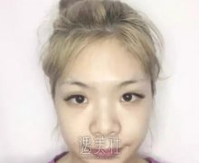 陈芝双眼皮案例|术后心情美美哒! width=