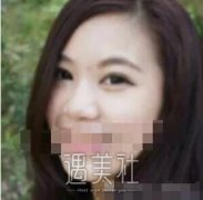 全国隆鼻专家前十名单公布｜内含于智宏隆鼻案例 width=