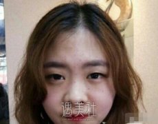 张毅双眼皮案例展示|回头率瞬间提升! width=