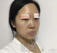 张恒术双眼皮案例及果图展示|看看其技术到底如何! width=
