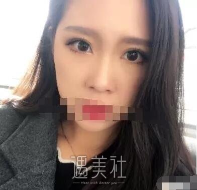 张恒术双眼皮案例及果图展示|看看其技术到底如何!