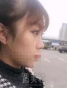 张怀军的隆鼻案例|魅力瞬间提升! width=