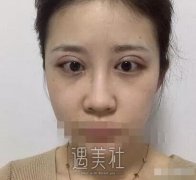 张黎双眼皮案例分享|终于小眼变大眼了! width=