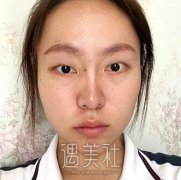 王国明双眼皮案例：术前术后恢复过程对比图~ width=