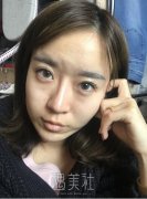 王先成隆鼻案例：打造自然天生鼻子~ width=