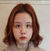 王志坚隆鼻案例：隆鼻改变人生命运~ width=