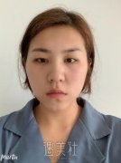 吴振双眼皮案例：真实恢复过程图~ width=