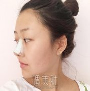 张正文隆鼻案例：垫鼻梁+缩鼻翼真实恢复过程~ width=