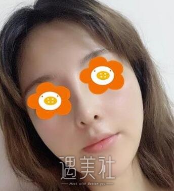南京,李俊,隆鼻