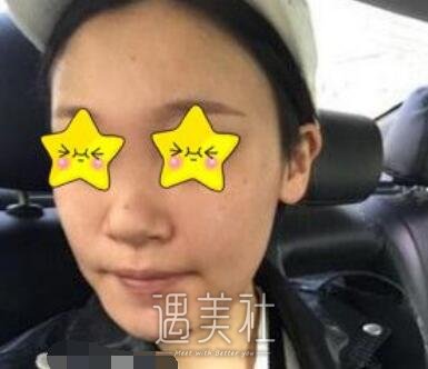 马鼻子,隆鼻