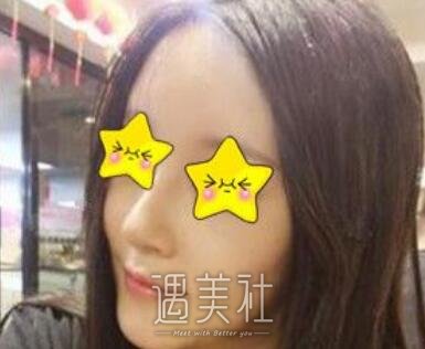马鼻子,隆鼻