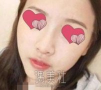 深圳福田武警医院隆鼻案例:整个脸都比较立体了 width=